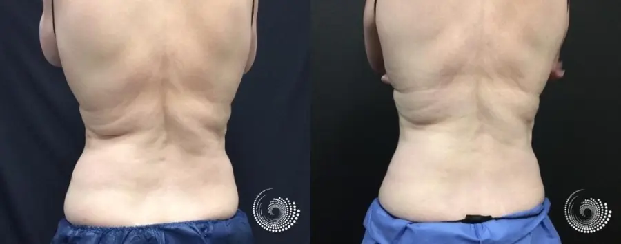 CoolSculpting Elite for stubborn fat on abs and flanks - Before and After 4