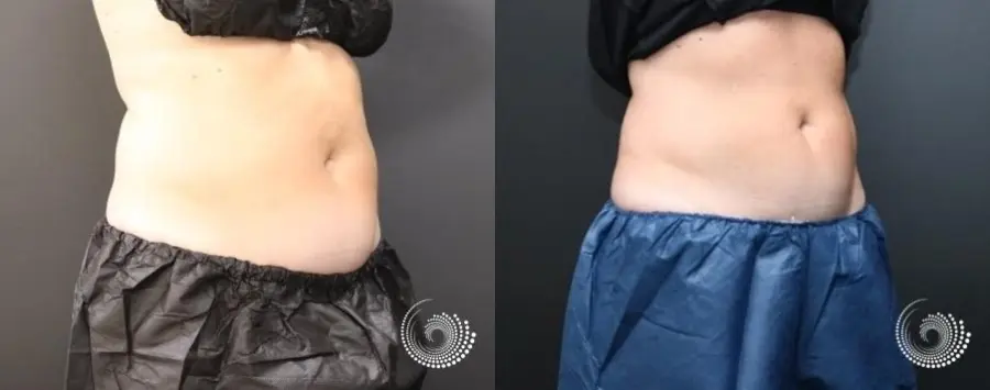 CoolSculpting Elite treatment – stubborn fat in her abdominal area - Before and After 3