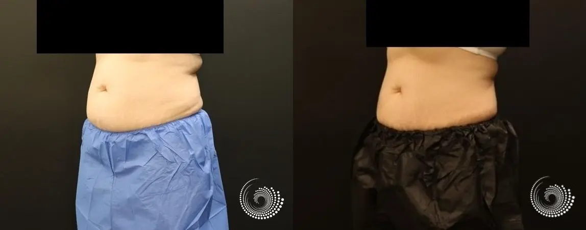 CoolSculpting reduces stubborn fat in abs and flanks - Before and After 4