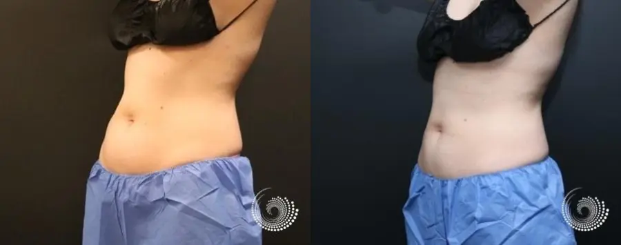 CoolSculpting Elite to reduce fat on abs and flanks - Before and After 5