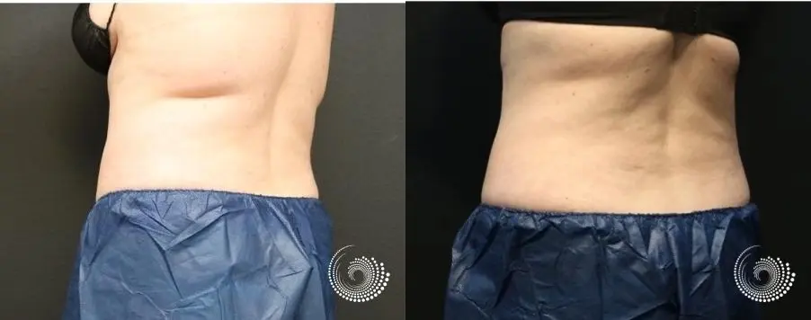 CoolSculpting Elite treatment - fat on flanks - Before and After 4