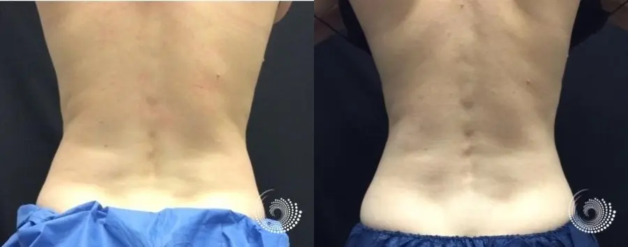 CoolSculpting Elite treatment - fat on abs and flanks - Before and After 2
