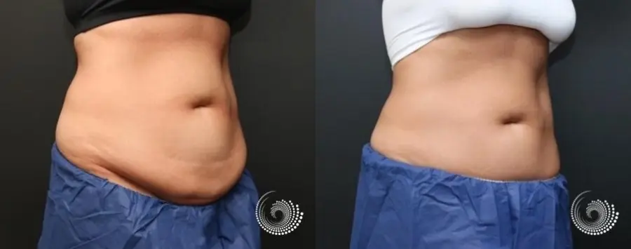 CoolSculpting Elite for her stubborn fat on abs and flanks - Before and After 4