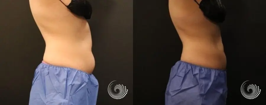 CoolSculpting Elite to reduce fat on abs and flanks - Before and After 1
