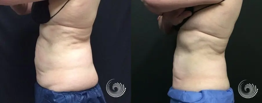 CoolSculpting Elite for stubborn fat on abs and flanks - Before and After 2