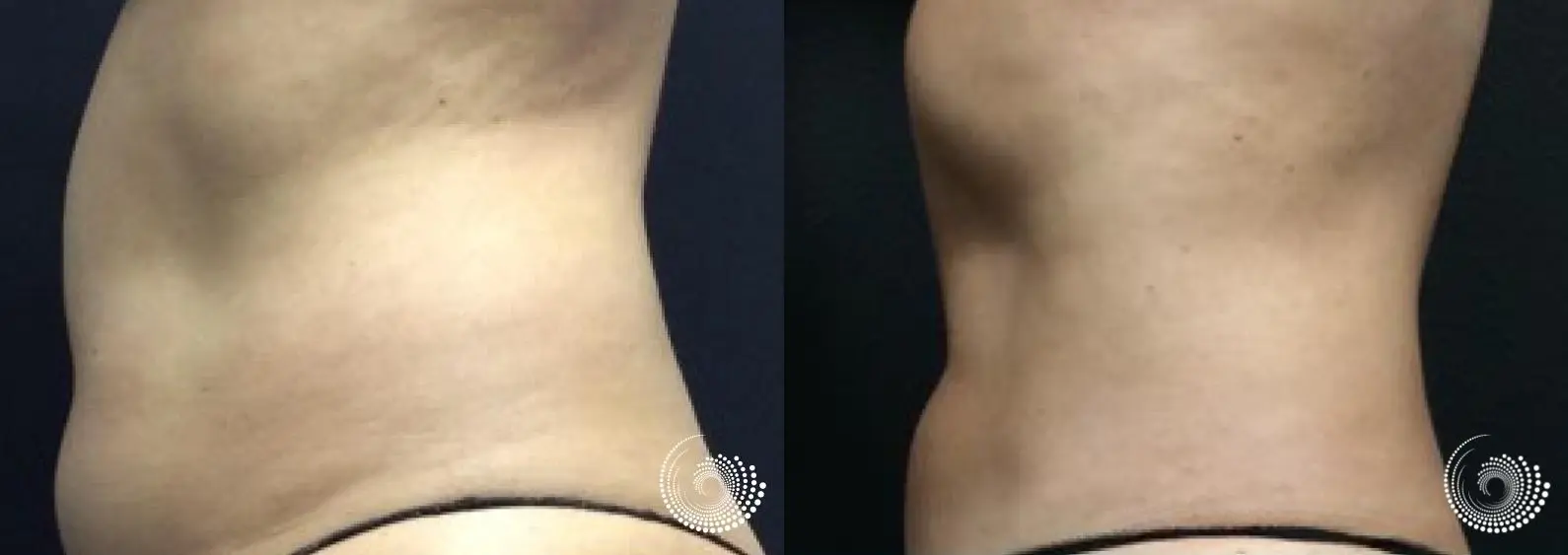 CoolSculpting Elite, reducing fat on tummy & flanks, before and after