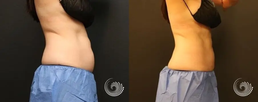 EMSCULPT builds muscle and tones bodies - Before and After 1