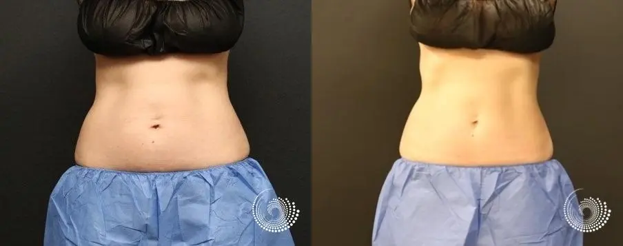 EMSCULPT builds muscle and tones bodies - Before and After 2