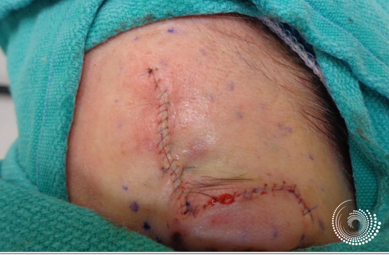 Basal Cell skin cancer, forehead near eyebrow - Mohs surgery - Before and After 3