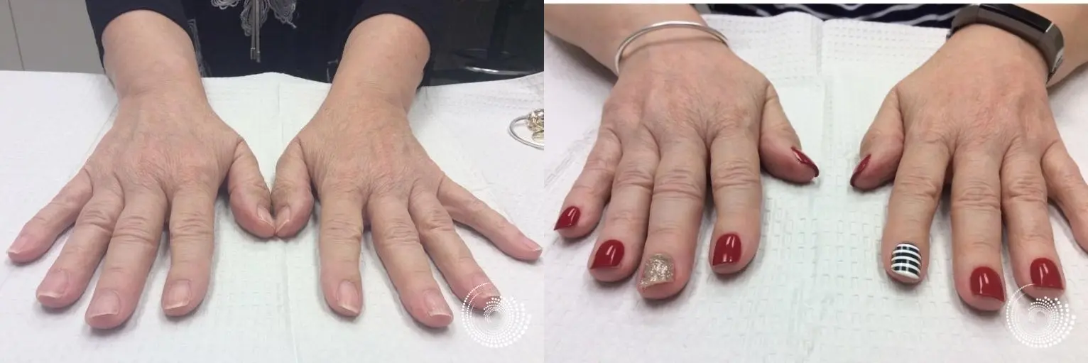 Filler - Hands: Patient 1 - Before and After 2