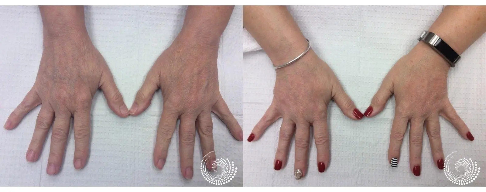 Radiesse Filler to Rejuvenate Aging Hands - Before and After