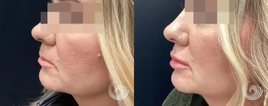 Cosmetic filler injections - Lip augmentation - Before and After 3