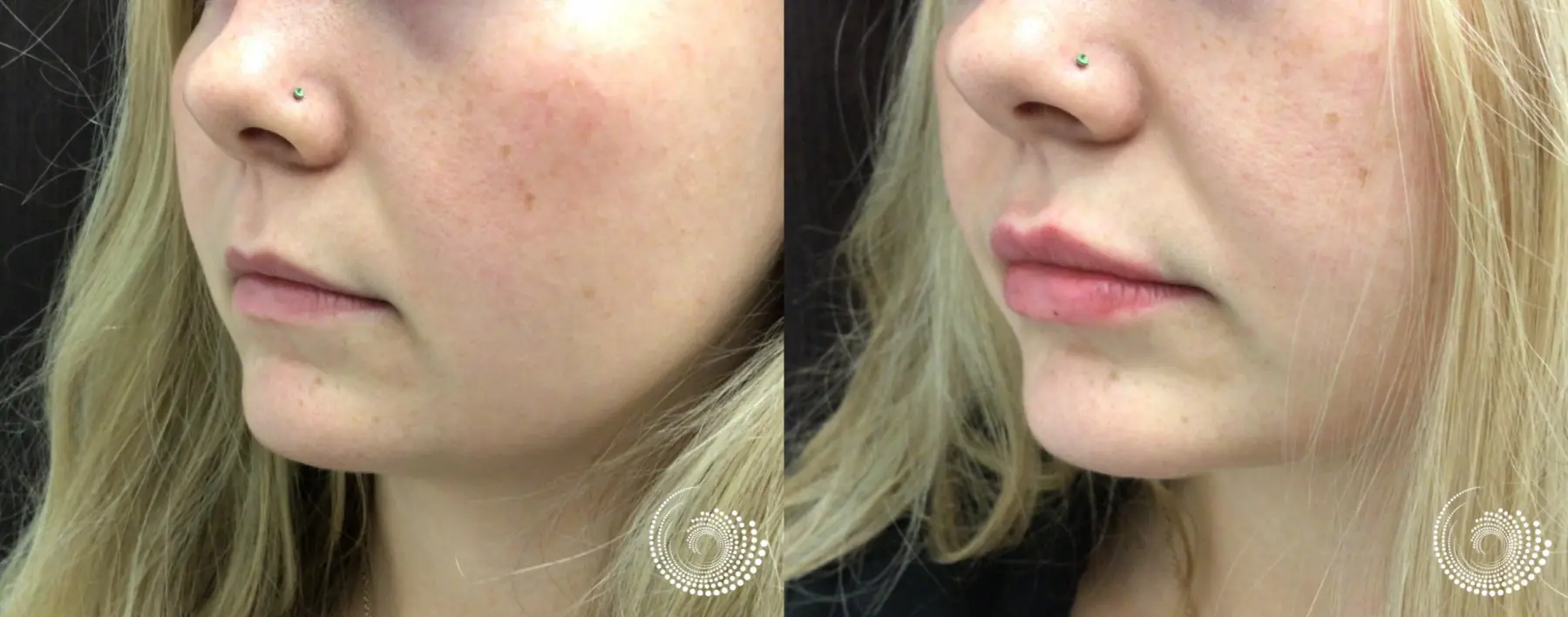Juvederm Volbella for Soft, Youthful Lips - Before and After