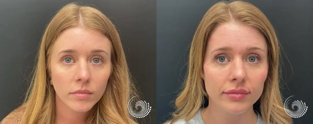 Facial Balancing with Filler | Fayetteville, AR - Before and After
