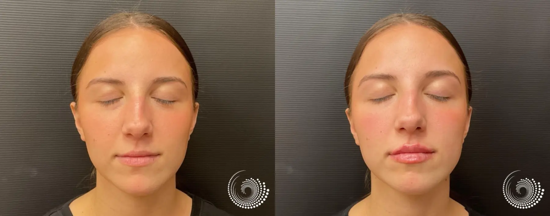 Youthful Lip Enhancement with Filler - Before and After