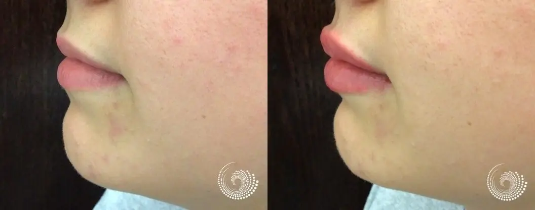 Filler - Lips: Patient 2 - Before and After 3