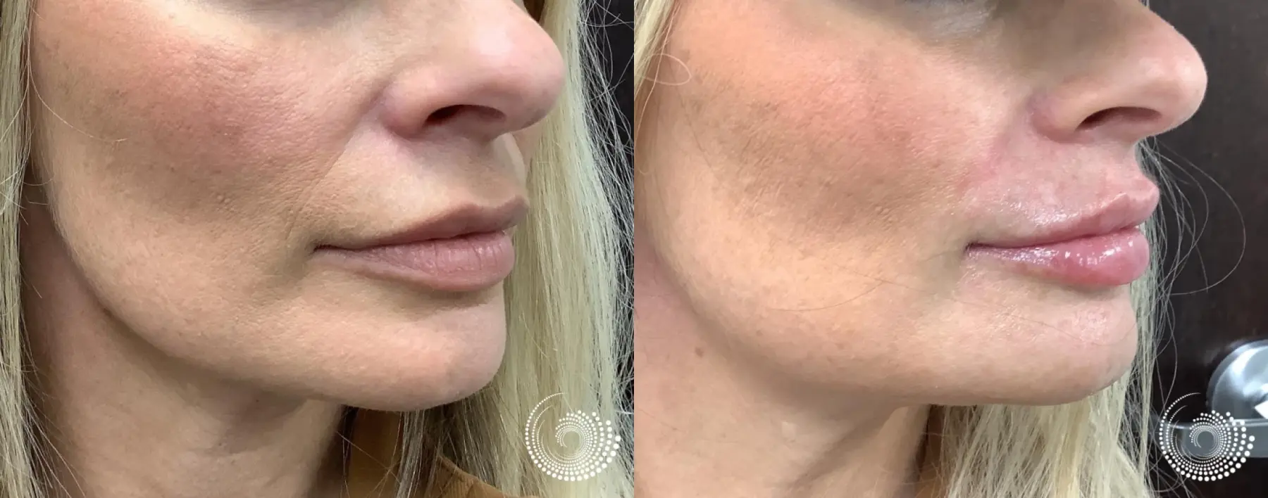 Cosmetic filler injections - vermillion lips and smile lines - Before and After 2