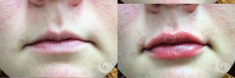 HA Lip filler injections to fill out thin lips - Before and After 1