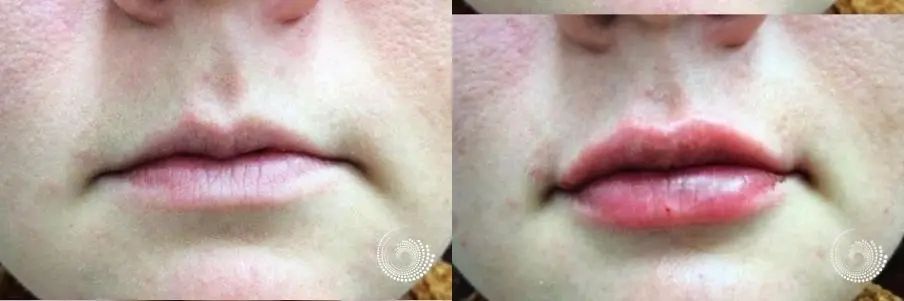 HA Lip filler injections to fill out thin lips - Before and After