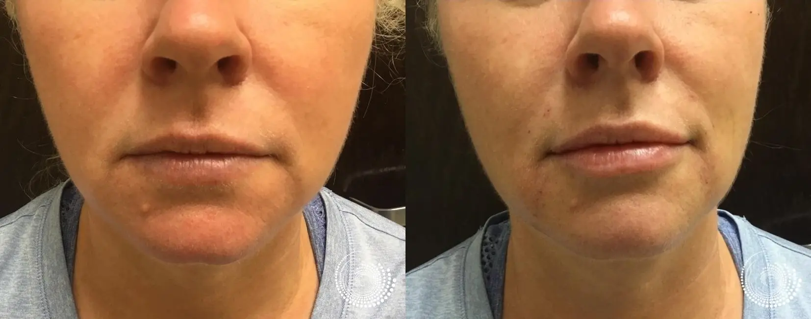 Juvederm Lip Filler by Dr. Lindley - Before and After