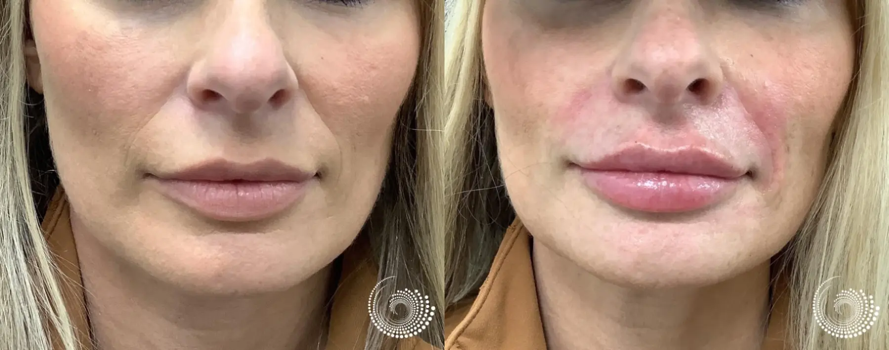 Cosmetic filler injections - vermillion lips and smile lines - Before and After