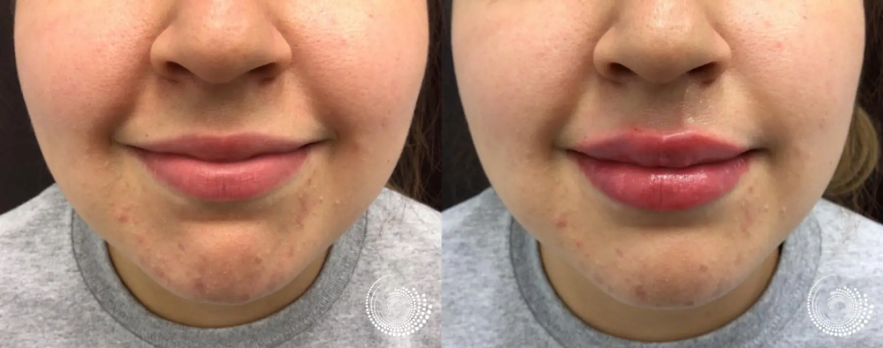 Filler - Lips: Patient 2 - Before and After 5