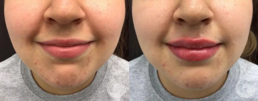 Filler - Lips: Patient 2 - Before and After 5