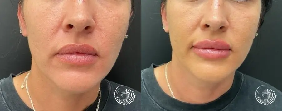 Natural Lip Filler for Fuller Lips - Before and After