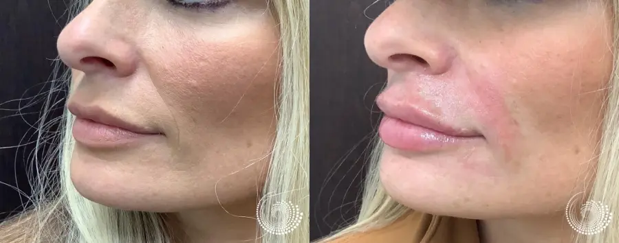 Cosmetic filler injections - vermillion lips and smile lines - Before and After 5