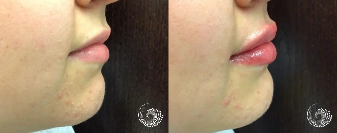 Filler - Lips: Patient 2 - Before and After 2