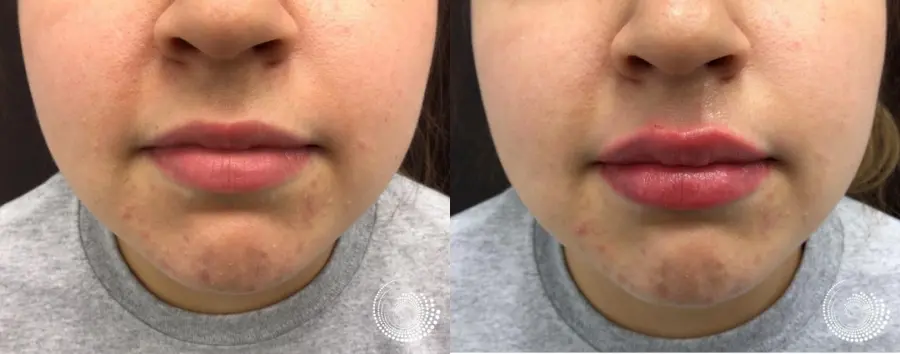 Filler - Lips: Patient 2 - Before and After 4