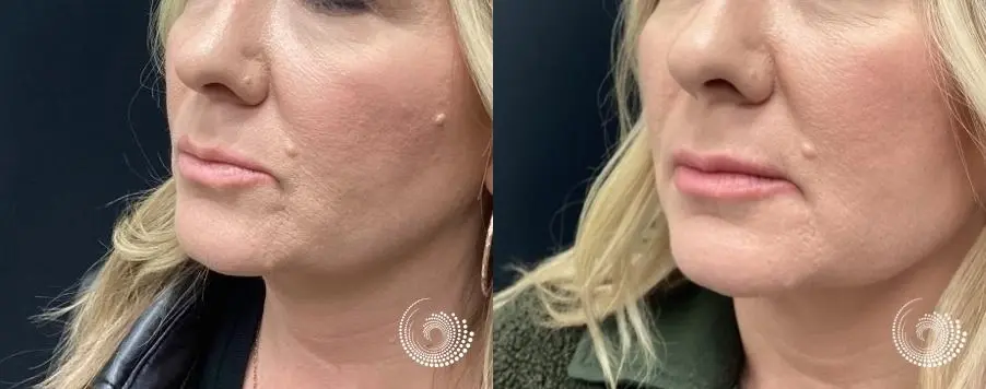 Cosmetic filler injections - Lip augmentation - Before and After 1