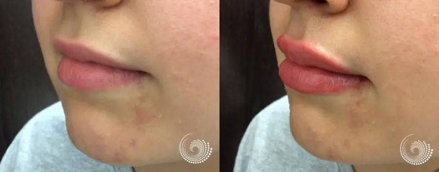 Filler - Lips: Patient 2 - Before and After 1