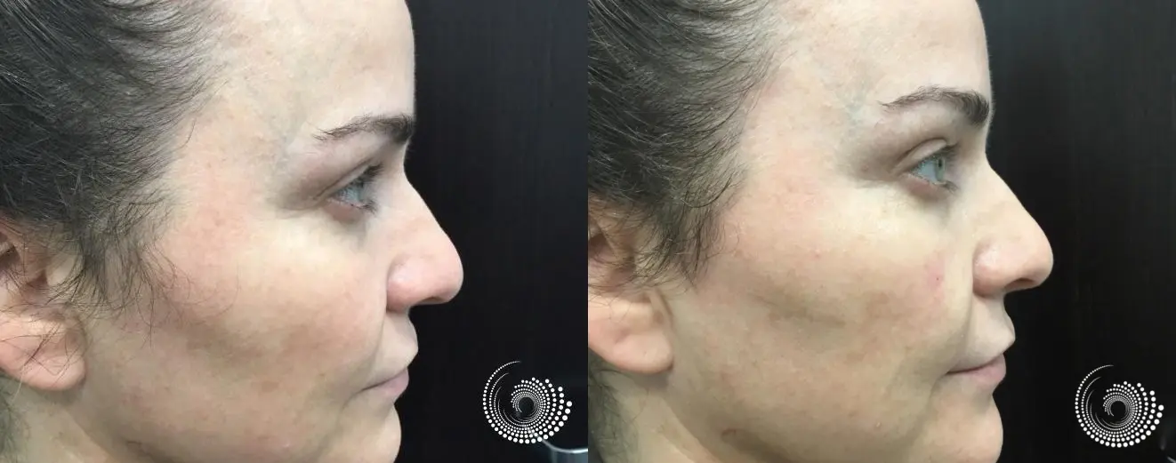 Tear tough filler to reduce under eye dark circles - Before and After 3