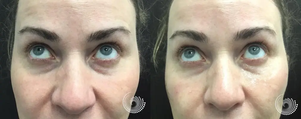 Tear tough filler to reduce under eye dark circles - Before and After