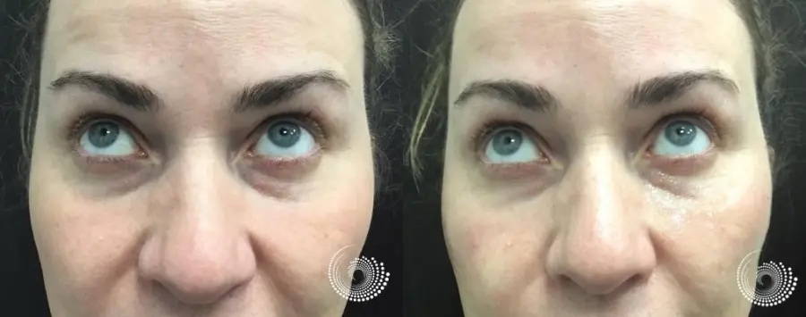 Tear tough filler to reduce under eye dark circles - Before and After 1