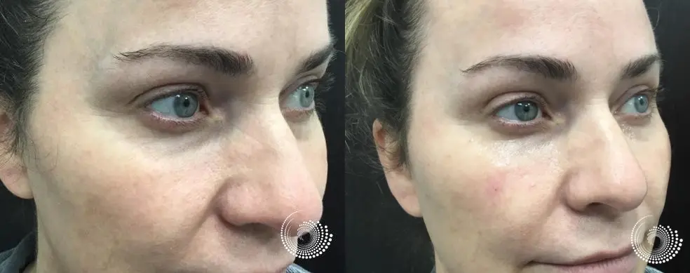 Tear tough filler to reduce under eye dark circles - Before and After 2