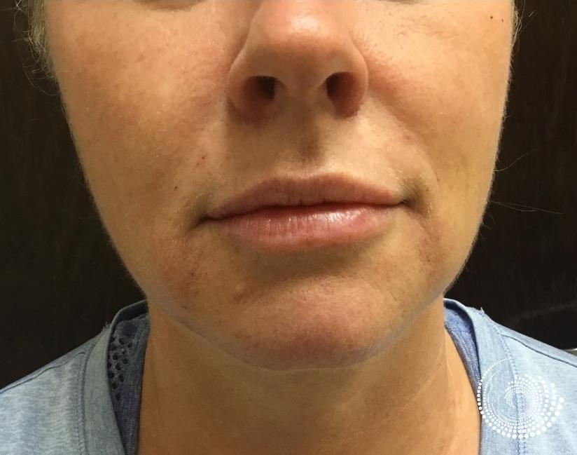 Filler - Lips: Patient 3 - After  