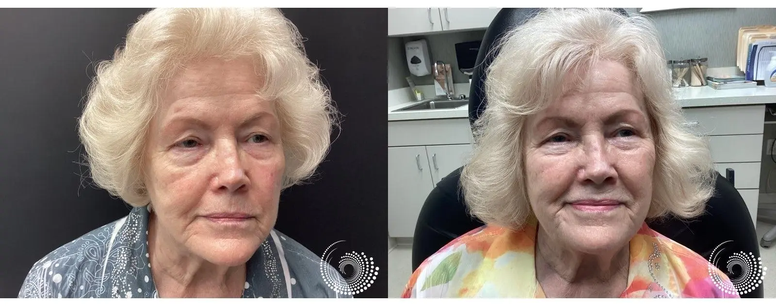Client Story: 81-Year-Old Patient Achieves Refreshed, Radiant Skin with Genius RF Microneedling - Before and After