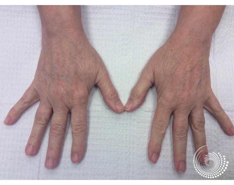 Filler - Hands: Patient 1 - Before 
