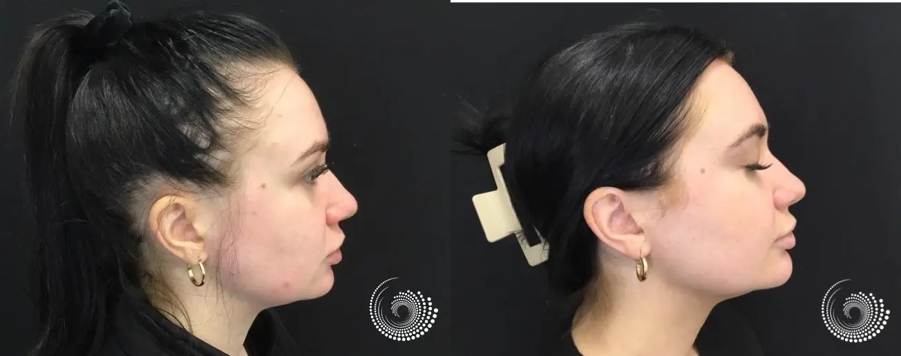 26-Year-Old AviClear Treatment: Stunning Before and After Photos - Before and After