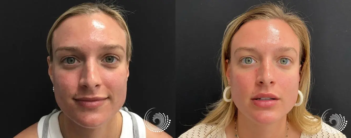 Remarkable AviClear Before and After Pictures: 27-Year-Old's Transformation - Before and After