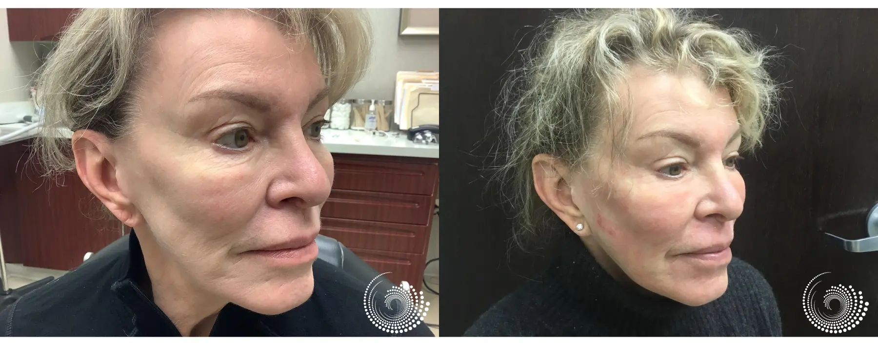 Pearl Fusion for Skin Rejuvenation - Before and After
