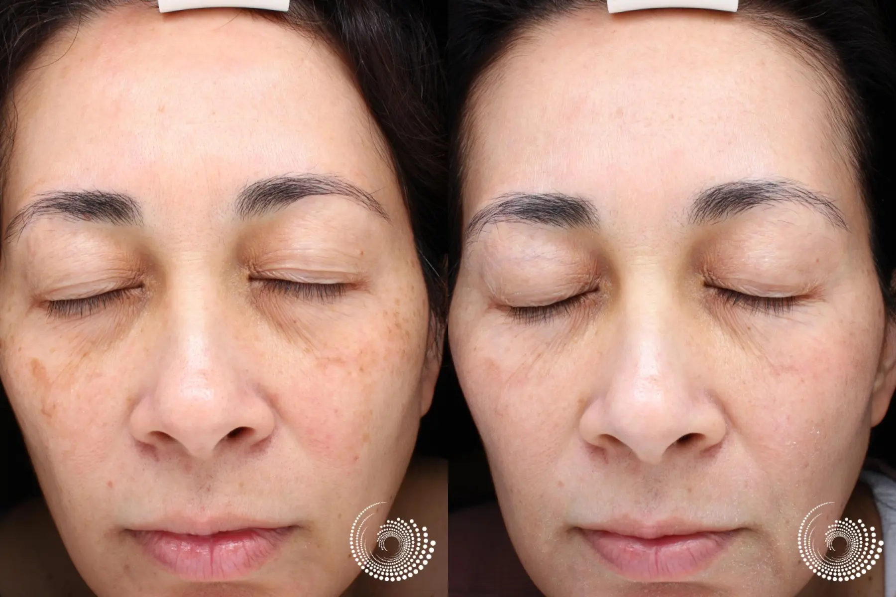 Lutronic Ultra Laser Fades Facial Pigmentation - Before and After