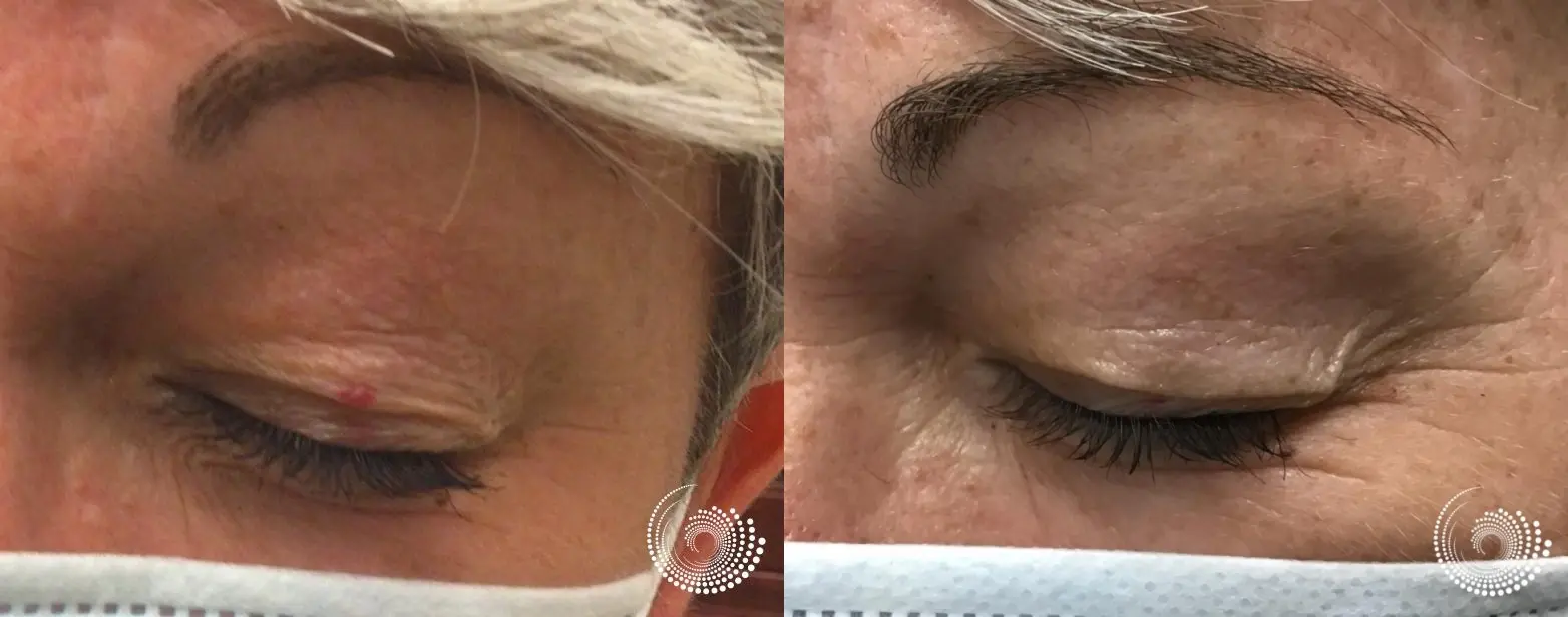Laser treatments for cherry angiomas - Before and After 1