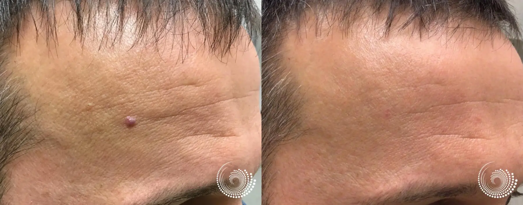 Laser - YAG: Patient 1 - Before and After  