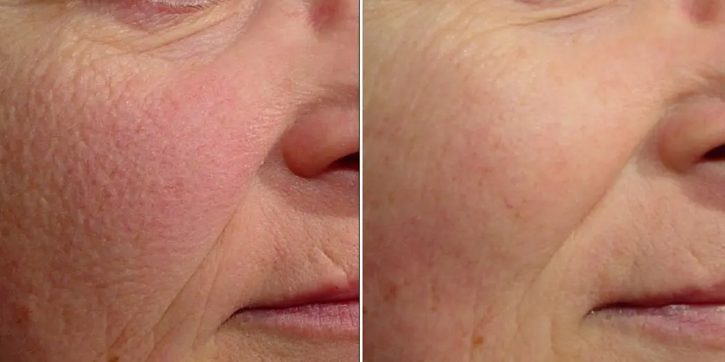 Laser Genesis for Cheek Redness & Wrinkles - Before and After