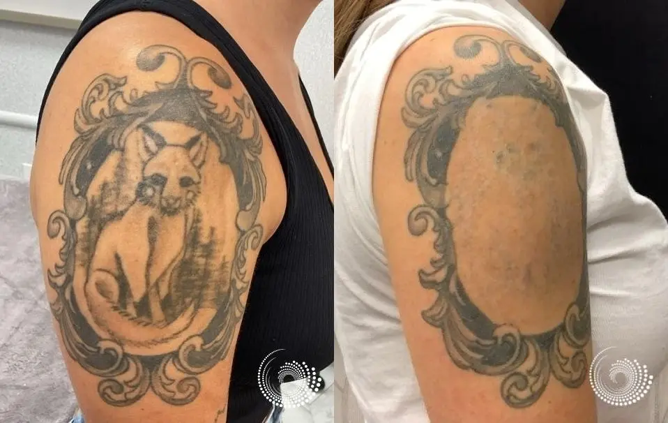 Laser Tattoo Removal, New Beginning - Before and After