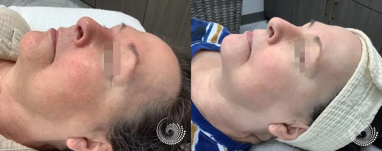 Limelight: Patient 4 - Before and After  