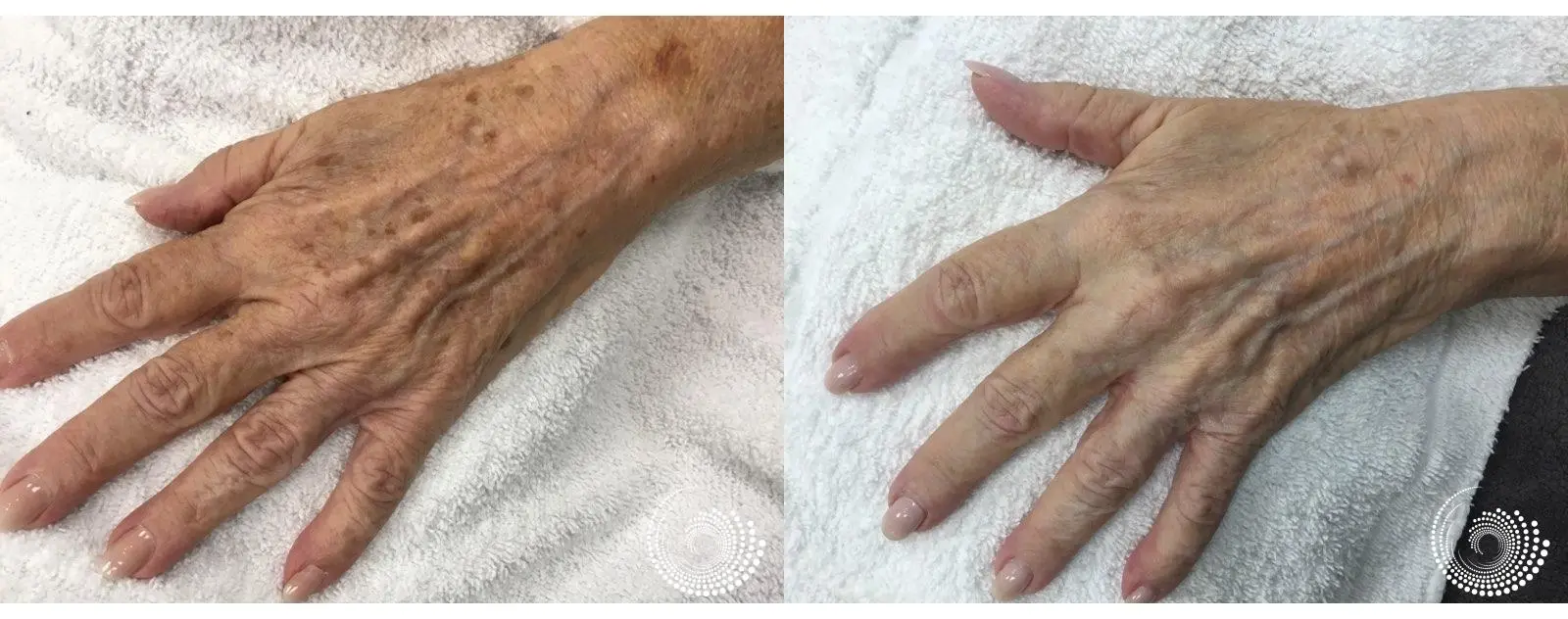 Limelight treats noticeable signs of sun damage on the hands - Before and After